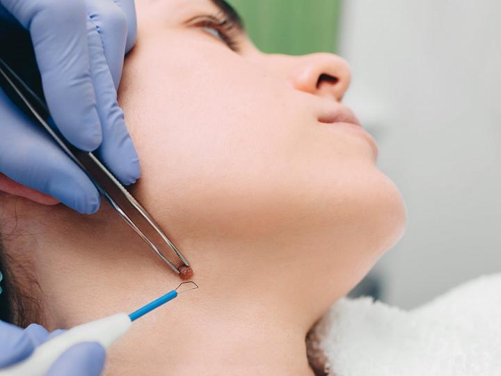 Mole Removal in Dubai