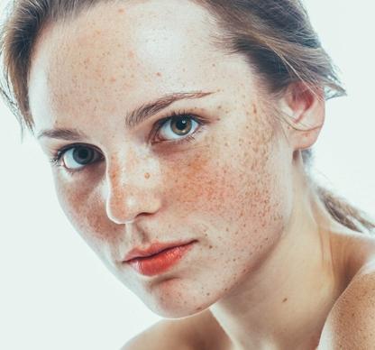 Melasma Treatment in Dubai